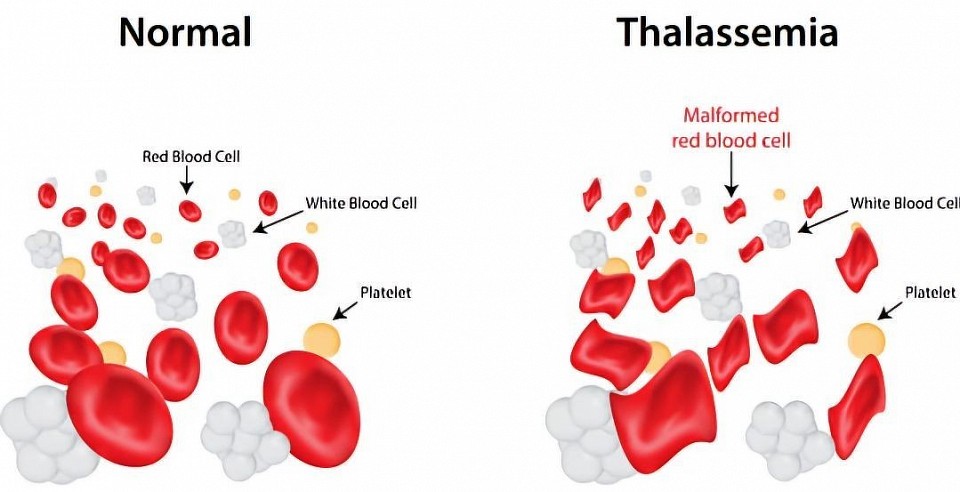 Talassemia